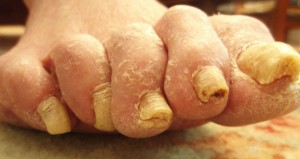 all-toes-infected9