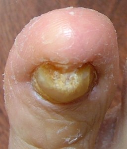 closeup-big-toe-nail