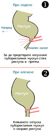 puborectal_sling